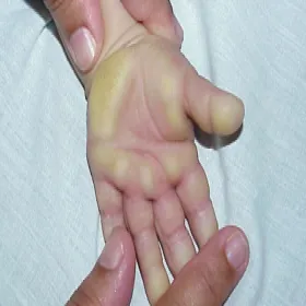 Rogowacenie skóry u dziecka