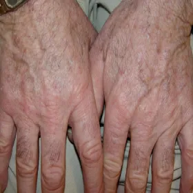 Rogowacenie starcze na dłoniach