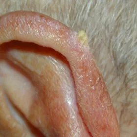 Rogowacenie starcze na uchu