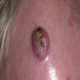 Rogowiak kolczystokomórkowy (keratoacanthoma)