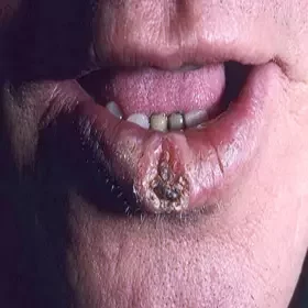 Rogowiak kolczystokomórkowy choroby ust