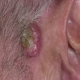 Rogowiak kolczystokomórkowy guz za uchem