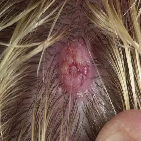 Rogowiak kolczystokomórkowy guzek na skórze głowy