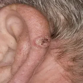 Rogowiak kolczystokomórkowy guzek narośl na uchu