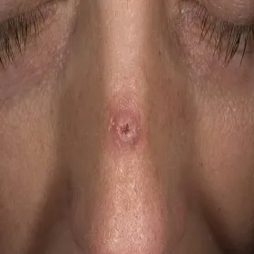 Rogowiak kolczystokomórkowy na nosie