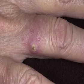 Rogowiak kolczystokomórkowy na palcu