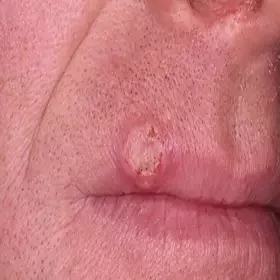 Rogowiak kolczystokomórkowy na ustach