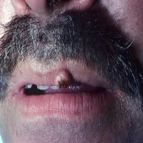 Rogowiak kolczystokomórkowy pojedynczy guz na wardze