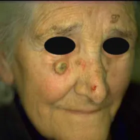 Rogowiak kolczystokomórkowy u starszej osoby