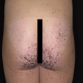 Rogowiec krwawy na pośladkach