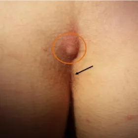 Ropień szpary międzypośladkowej