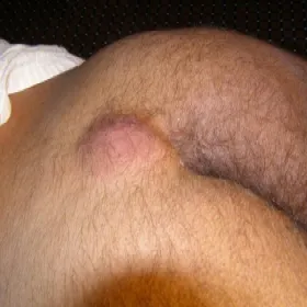 Ropień w okolicy krzyżowo guzicznej