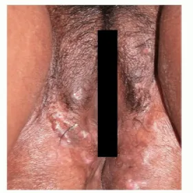 Ropne zapalenie apokrynowych gruczołów potowych sromu