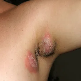 Ropne zapalenie apokrynowych gruczołów potowych 