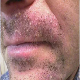 Ropne zapalenie mieszków włosowych skóry wąsów
