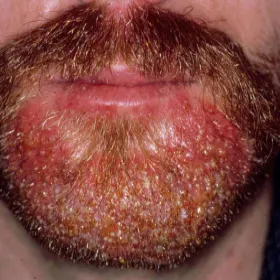 Ropne zapalenie skóry mieszków włosowych figówka