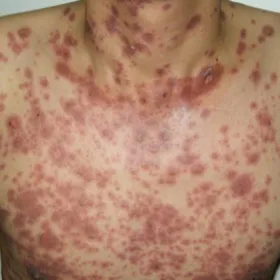 Rozlana wysypka plamisto-grudkowa w przebiegu martwicy toksyczno-rozpływnej naskórka