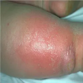 Rumień choroba róża