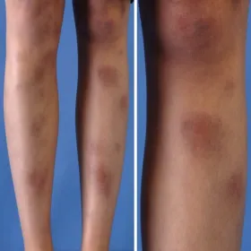 Rumień guzowaty jak wygląda