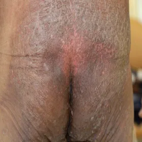 Rumień lombardzki objawy skórne