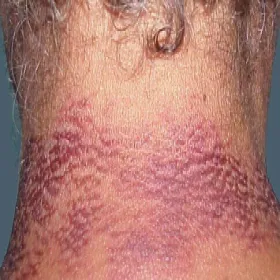 Rumień na szyi pelagra