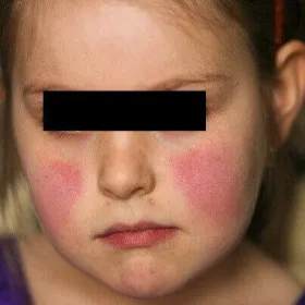 Rumień na twarzy u dziecka