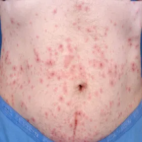 Rumień wielopostaciowy erythema multiforme 