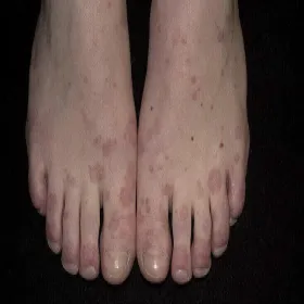 Rumień wielopostaciowy na stopach