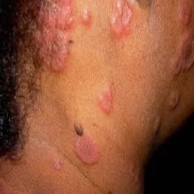 Rumień wielopostaciowy na szyi