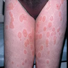 Rumień wielopostaciowy na udach