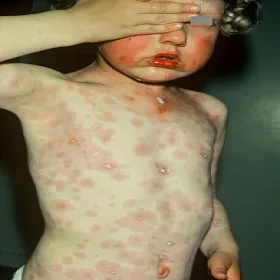 Rumień wielopostaciowy u dziecka