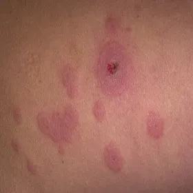 Rumień wielopostaciowy 