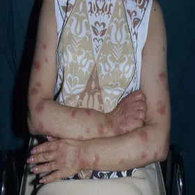 Rumień wysiękowy wielopostaciowy