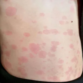Rumień zakaźny u dorosłego na skórze