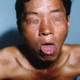 Rumień lombardzki obrazy