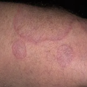 Rumienie na skórze ziarniniak obrączkowaty 