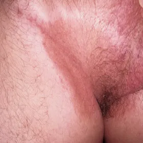 Rumieniowe zmiany skórne w obrębie pachwin erythrasma 