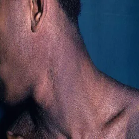 Rybia łuska na szyi