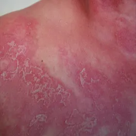 Rzadkie choroby skóry zdjęcia choroba Sneddona