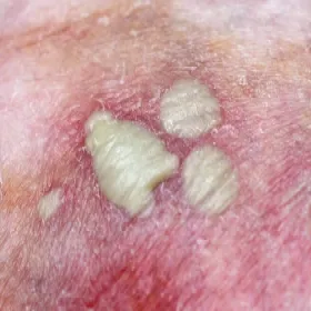 Rzadkie choroby skóry zdjęcia