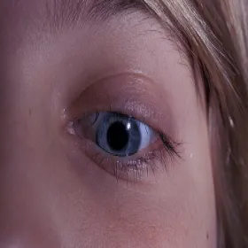 Rzadkie rzęsy łysienie plackowate