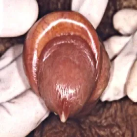 Rzeżączka u mężczyzn zdjęcia