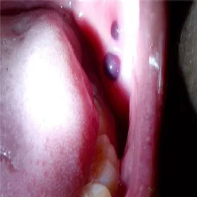 Rzeżączka w jamie ustnej