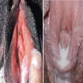 Rzeżączka objawy u kobiet