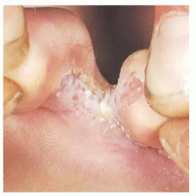 Schodząca skóra między palcami u nóg stopa sportowca 