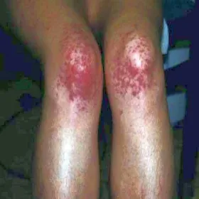 Skaza krwotoczna  małopłytkowość immunologiczna