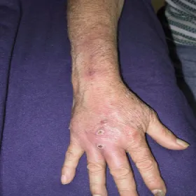 Sporothrix schenckii choroba