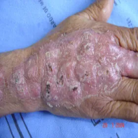 Sporotrychoza choroba zakaźna skóry