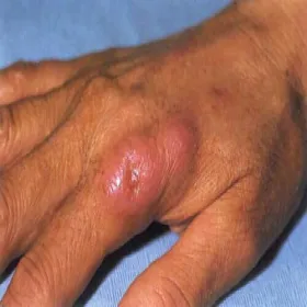 Sporotrychoza choroba