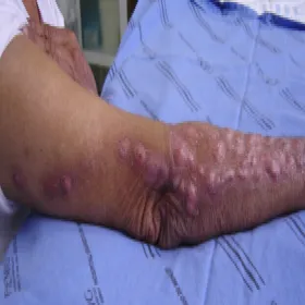 Sporotrychoza grzyb Sporothrix schenckii 